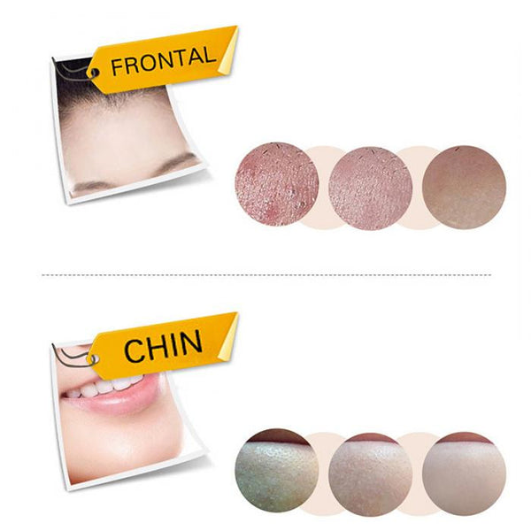 Black Head Remover (Free Shipping)