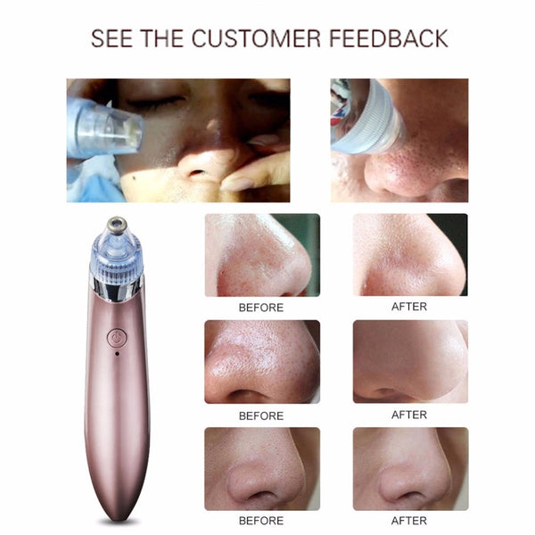 Blackhead Eliminator